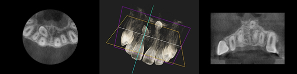歯科用3D-CT